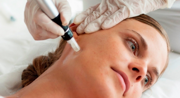 microneedling